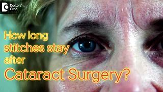 Duration for which stitches stay in after Cataract Surgery - Dr. Sriram Ramalingam