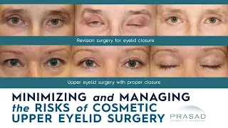 Risks of Cosmetic Upper Eyelid Surgery, and How they are Minimized and Managed