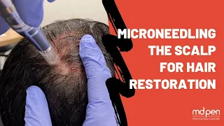 Microneedling The Scalp For Hair Restoration | MDPen