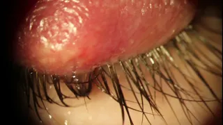 Huge External Hordeolum Stye - Lanced and Milked