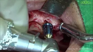 Trailer about Core technique and its application by Universal kit #dental implant