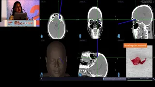 AIOC2019 GP098 Topic 4  Navigation Guided Orbital Surgery:   Dr  Priti Udhay