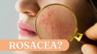 Rosacea: Was steckt hinter der Hautkrankheit?