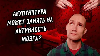 Акупунктура влияет на мозг l Иглоукалывание в психиатрии