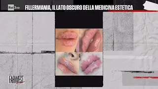 Filler mania, il lato oscuro della medicina estetica - FarWest 11/12/2023