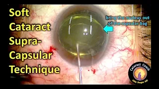 Soft Cataract SupraCapsular Technique