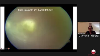 "Approach To Posterior Uveitis"