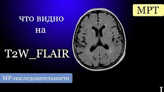 Базовые лекции по МРТ /  МР-последовательности: T2W_FLAIR