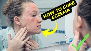 How to cure eczema permanently : Proven Strategies for Lasting Relief