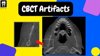 CBCT Artifacts | Basic CBCT| CBCT basic understanding | Cone beam computed tomography