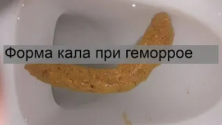 Форма кала при геморрое