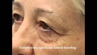 Upper Lid Blepharoplasty, Eyebrow Ptosis, and Lateral Hooding