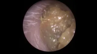 Long slippery plug of wax resists removal