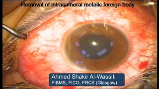 Metallic intracameral foreign body removal