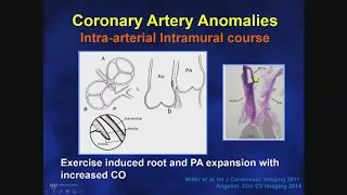 Adult Congenital Heart Disease: Anomalous Coronary Arteries (Risk Stratification)