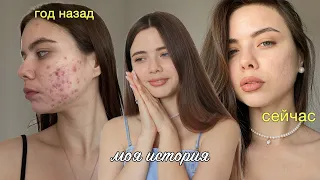 Я ВЫЛЕЧИЛА КОЖУ! 13 ЛЕТ БОРЬБЫ С АКНЕ И ПОВТОРНЫЙ КУРС РОАККУТАНА