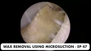 EAR WAX REMOVAL USING MICROSUCTION - EP 47