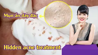 Cách điều trị mụn ẩn, mụn viêm hiệu quả tại Hiền Vân Spa| Hidden Acne Treatment |581