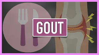 Gout | Emphasis on Diet/Nutrition