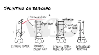 Principles of Fracture Fixation | Orthopedic Basics