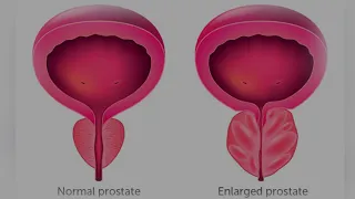 Natural Ways to Shrink Your Prostate gland