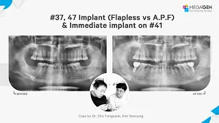 Dr. Yongseok CHO, Sewoung KIM,  #37, 47 Implant (Flapless vs A.P.F) & Immediate implant on #41