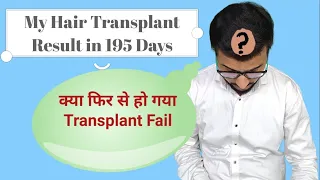 My Hair Transplant Failing Again? My 195 Days Post Hair Transplant  update | My Result in 6.5 month