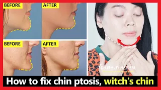 How to fix chin ptosis, witch's chin, chin correction, chin long, get beautiful chin without surgery