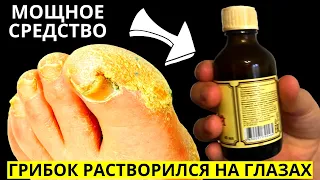 Эта ГРЕМУЧАЯ МОЩНЕЙШАЯ Советская Мазь Разъест Весь Грибок с Ногтей! Есть в Любой Аптеке!