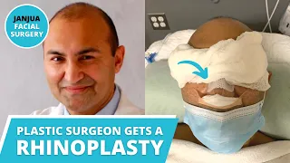 MY RHINOPLASTY JOURNEY - PLASTIC SURGEON GETS HIS NOSE DONE - DR. TANVEER JANJUA - NEW JERSEY