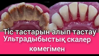 Профессиональная чистка зубов удаление зубного камня тис тастарын алу тіс тастарын тазалау | 18+ # 1