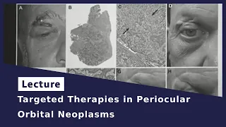 Targeted Therapies in Periocular Orbital Neoplasms