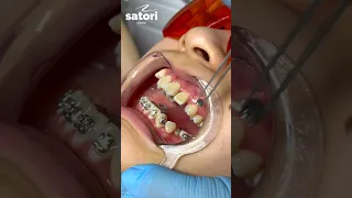 Fixing the braces