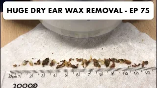 HUGE DRY EAR WAX REMOVAL - EP 75