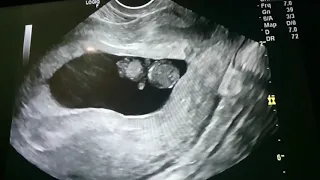 11 weeks miscarriage no heartbeat 😭👶👼 trans vaginal ultrasound (first pregnancy)