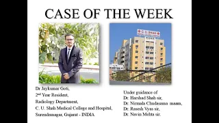 Case of the week - ACRANIA EXENCEPHALY ANENCEPHALY SEQUENCE