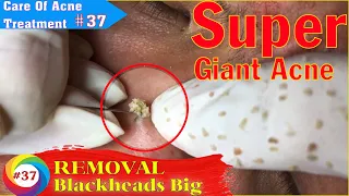 BIG  Blackheads Removal on Nose | Acne Treatment (#37)