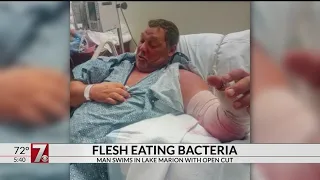 Man gets flesh eating bacteria after swimming in SC lake