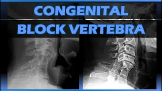 Congenital Block Vertebra #anatomy #anomaly #radiology