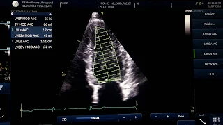 Ejection fraction measurement