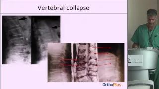 Fragility Fractures: Vertebroplasty - Kyphoplasty Are They Still Relevant? by Thomas Oberhofer, M.D.