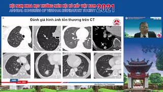 Cập nhật hướng dẫn theo dõi nốt mờ đơn độc tại phổi trên CT ngực