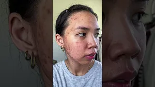 acne journey 🫶🥺 #shorts #acne #acnejourney #acneproneskin #acnetreatment