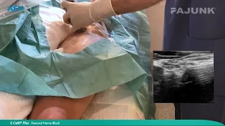 Femoral Nerve Block: E-Cath® Plus - Medizi.MVZ Stuttgart