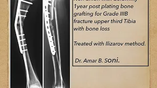 Non union with deformity- 1 year post plating bone grafting