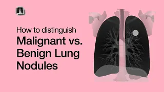 Distinguish Malignant vs. Benign Lung Nodules