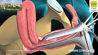 Endometrial Biopsy - CIMS Hospital