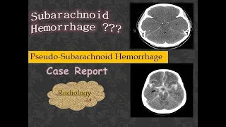 Case Report- Pseudo-Subarachnoid Hemorrhage V/S Subarachnoid Hemorrhage ?.CT Brain / Cerebral Edema