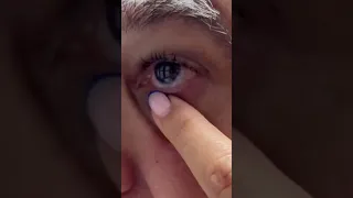 Insertion and Removal of Scleral Lenses