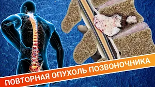 ВТОРИЧНАЯ ОПУХОЛЬ ПОЗВОНОЧНИКА